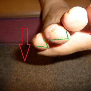 足の指の先の尖り…指先が三角形