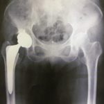 股関節の人工関節置換手術後のリハビリ