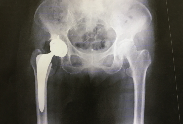 股関節の人工関節置換手術後のリハビリ