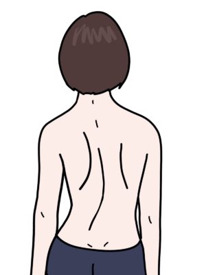 突発性側弯症　側弯症　礒谷式力学療法　西荻窪整体
