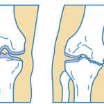 膝痛　関節の隙間　原因　西荻窪　整体　CS60
