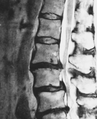 脊柱管狭窄症　腰痛　感受性　整体　西荻窪