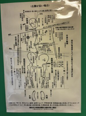 礒谷式力学療法の理論図、右脚が長いと起こる体の歪み