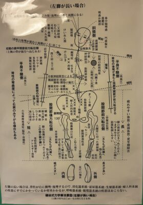 礒谷式力学療法の理論図、左脚が長いと起こる体の歪み